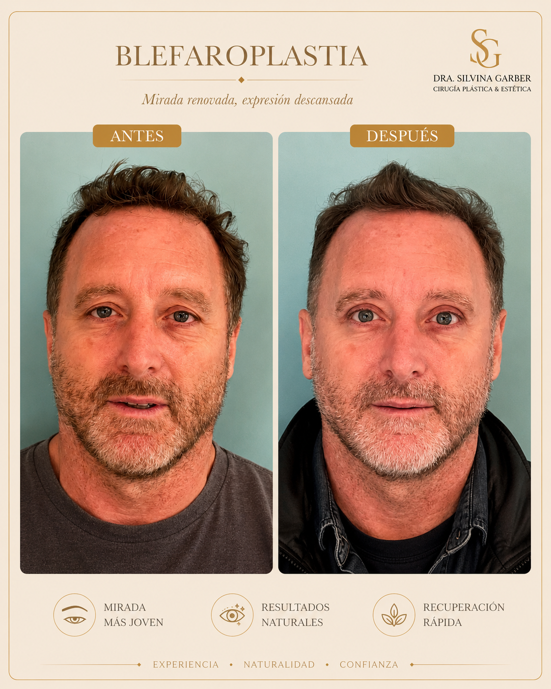 Resultado Blefaroplastia