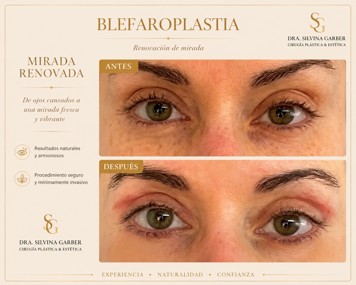 Resultado Blefaroplastia