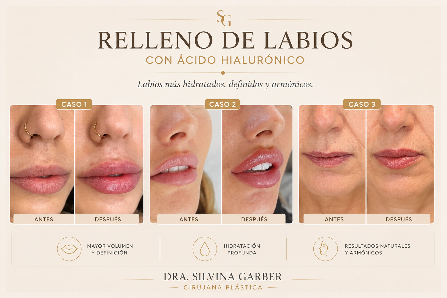 Resultado Labios Rusos