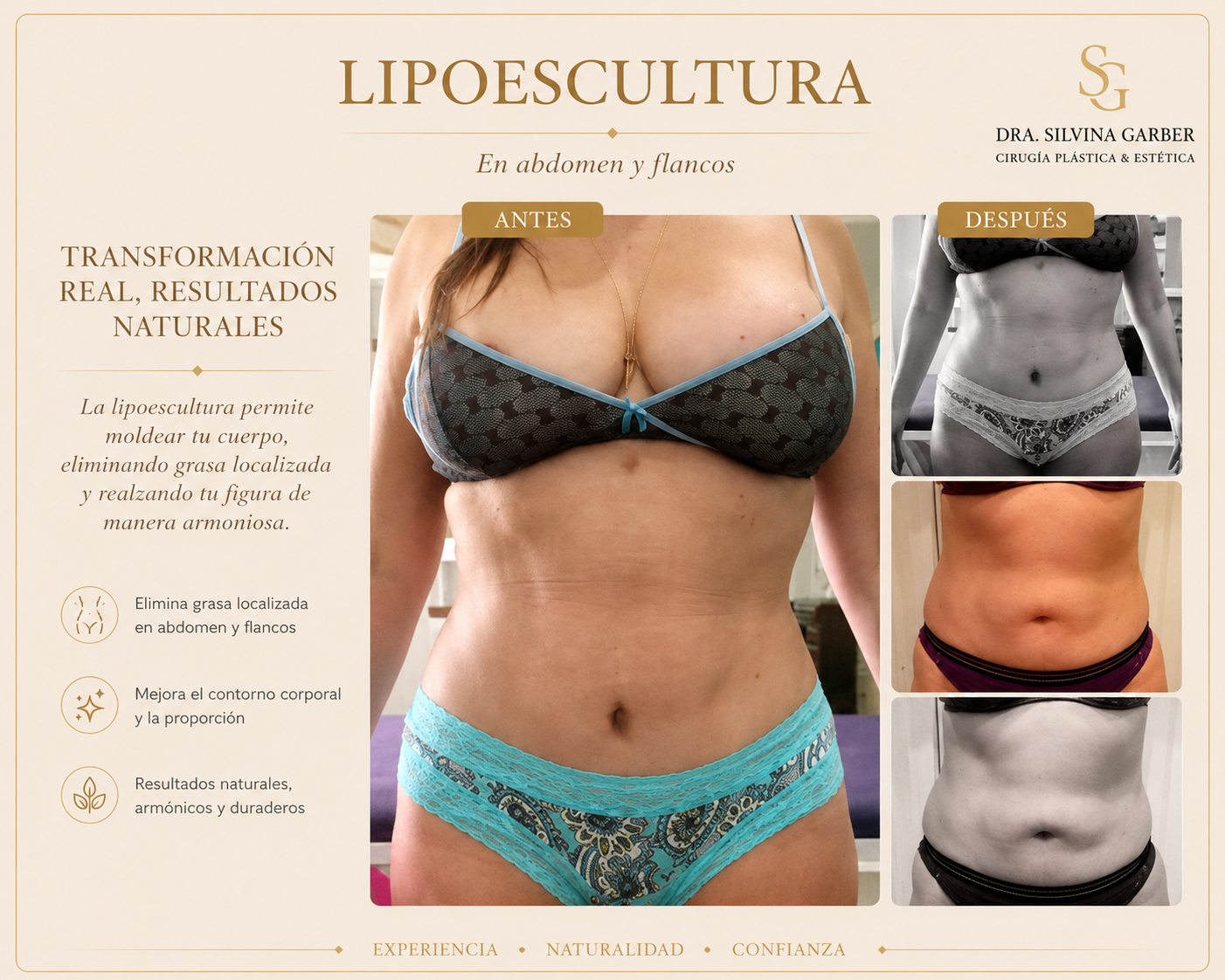 Resultado Lipoescultura