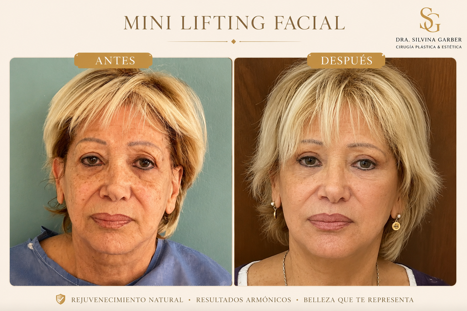 Resultado Mini Lifting