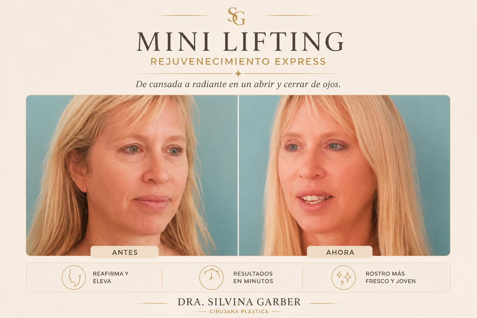 Resultado Mini Lifting