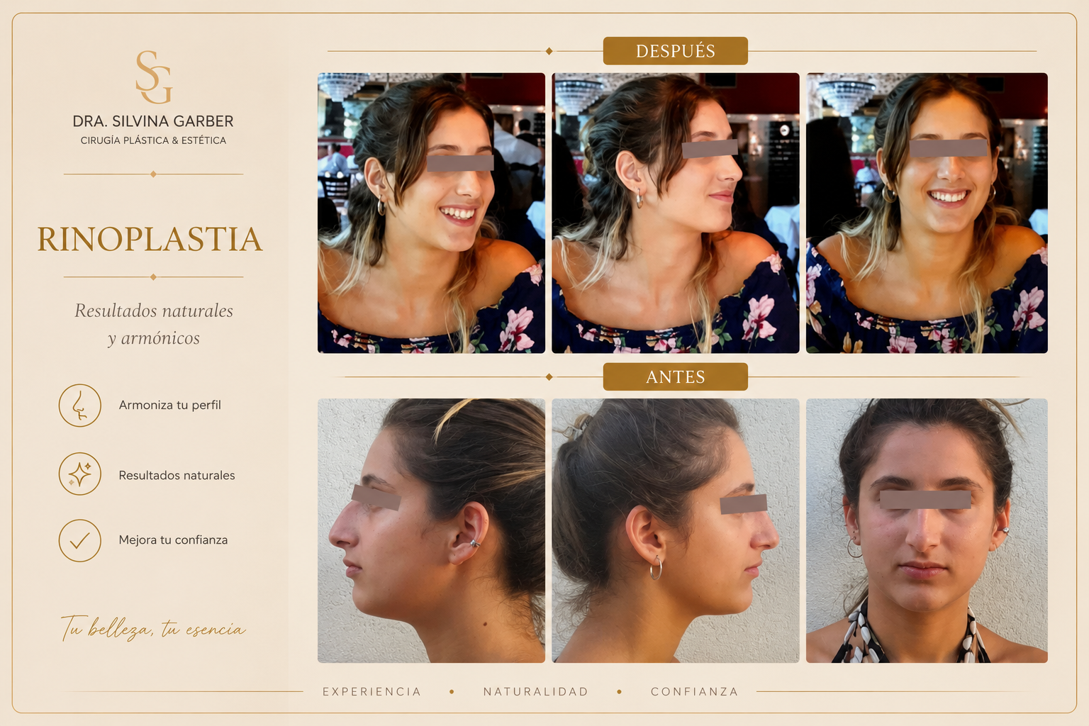 Resultado Rinoplastia